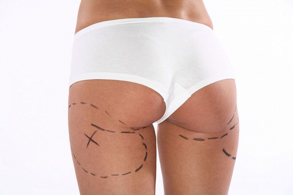 procedure cosmetiche per la perdita di peso